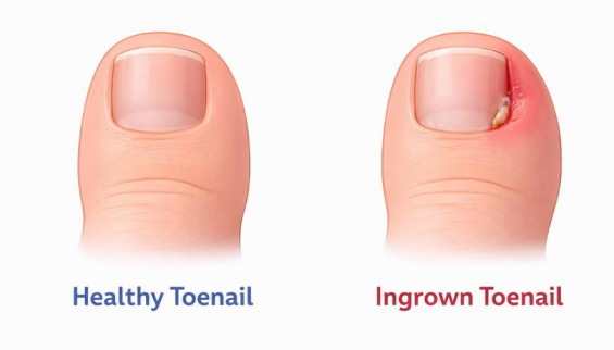 healthy toenail and ingrown toenail comparison