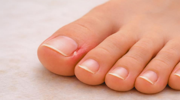 ingrown toenail