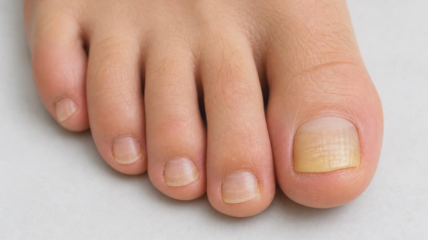 What causes toenail fungus showing mild nail discoloration and thickening